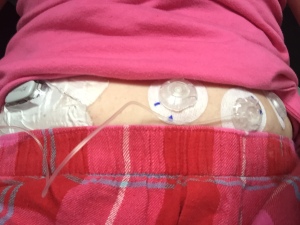 Real estate was hard to come by at this point! Extra pump sites and tape over the dexcom sensor...
